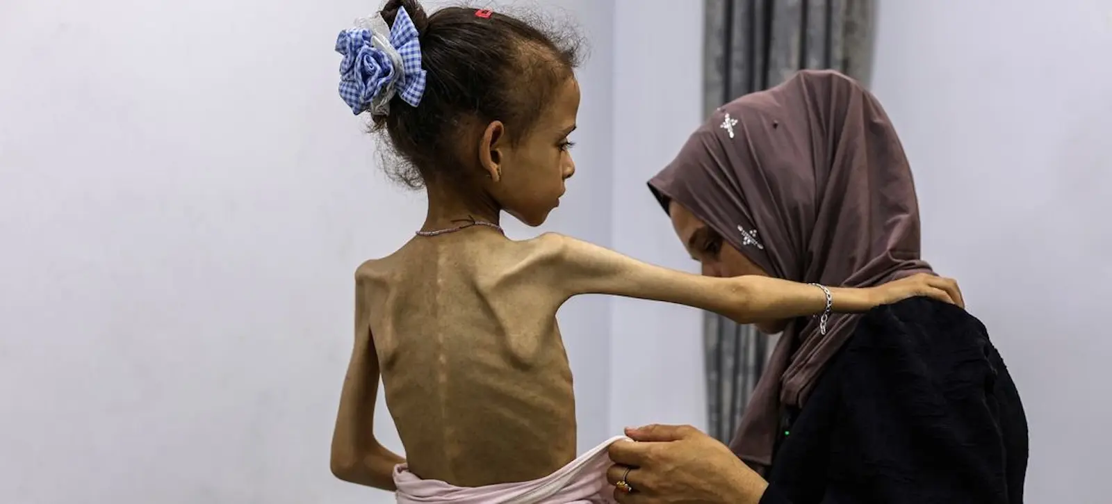 malnourished child gaza